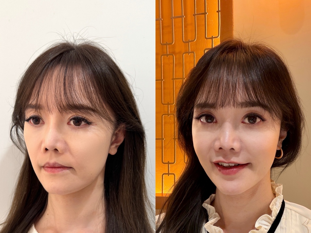 告別法令紋必看!幸衍醫美「仙女玻尿酸」法令紋填補實測自然減