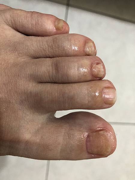 20200812灰指甲狀態 20200812灰指甲狀態