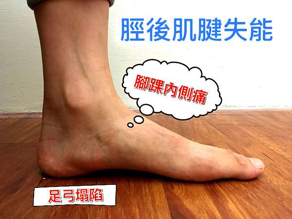 腳踝內側的痛 脛後肌腱失能 Posterior Tibial Tendon Dysfunction 張凱昇物理治療師 痞客邦