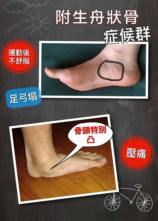 腳踝內側的骨頭特別突出 附生舟狀骨症候群 Accessory Navicular Syndrome 張凱昇物理治療師 痞客邦 腳踝內側的骨頭特別突出 附生舟狀骨症候群 Accessory Navicular Syndrome 張凱昇物理治療師 痞客邦