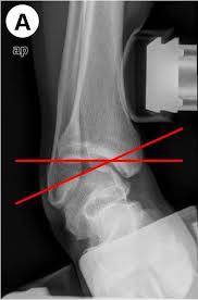 stress X ray 內向外 stress X ray 內向外
