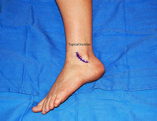 Image_Hayes_Lateral_Ankle_Incision