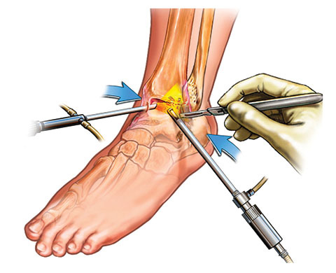 OS34-Arthroscopy-Ankle