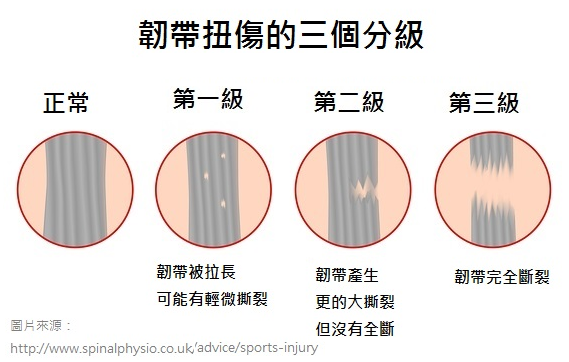 扭傷分級 扭傷分級