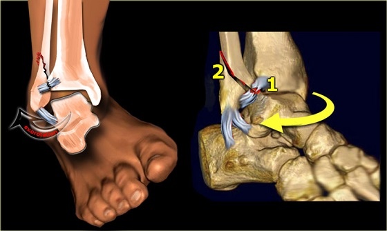 Avulsion fracture ankle