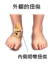 內側韌帶扭傷 內側韌帶扭傷