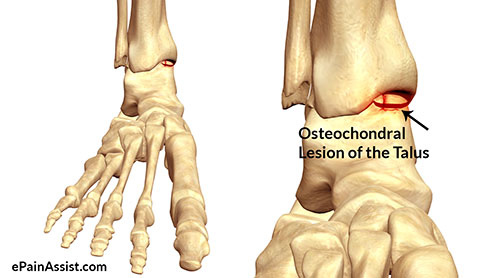 Osteochondral-Lesion-of-the-Talus-inner-image