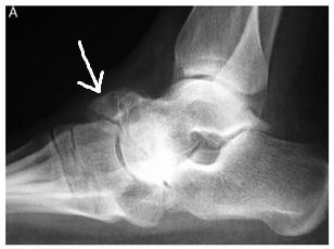 贅骨.png 贅骨.png