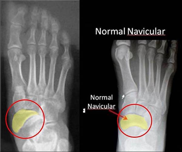 navicular 對照圖 2.jpg