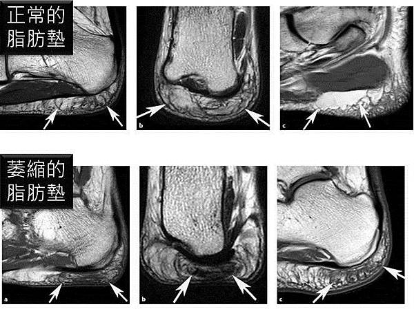 脂肪墊 MRI.jpg