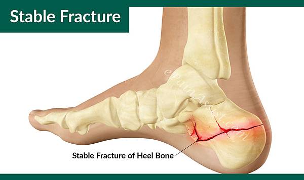 Stable-Fracture-of-Heel-Bone-1.jpg