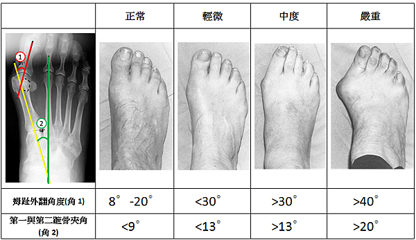 姆趾外翻程度表格.PNG 姆趾外翻程度表格.PNG