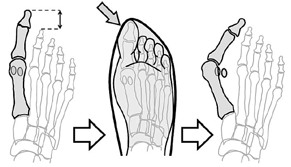 較長的大姆趾 (Munuera, Polo, %26; Rebollo, 2008).PNG 較長的大姆趾 (Munuera, Polo, %26; Rebollo, 2008).PNG