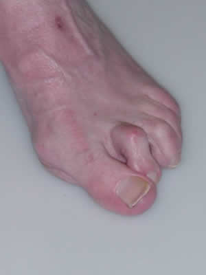 Hallux-valgus-hammer toe-1.jpg