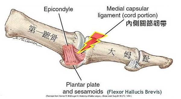 1 MTP ligament.jpg