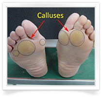 HV callus.png