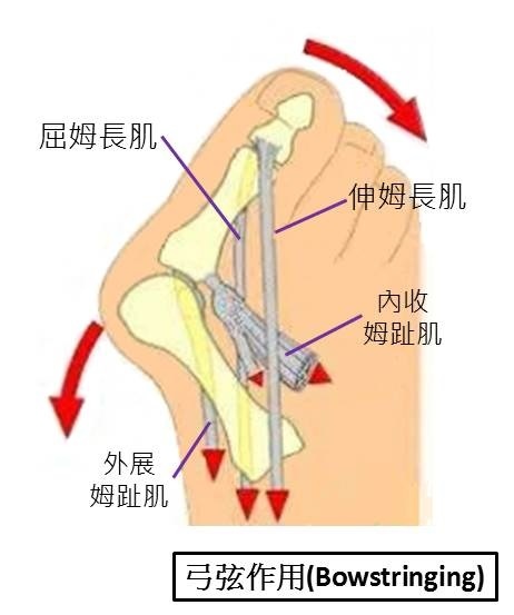 bowstringing -1.jpg