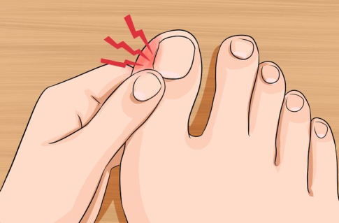 ingrown-toenail.png ingrown-toenail.png