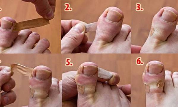 How-To-Heal-Ingrown-Toenail-At-Home-ml7j5p6c9fnez7fvold9ihxapxuight9vdfk2ghcis.jpg