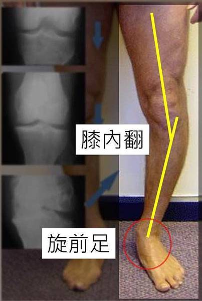 foot planus and knee varum 1.jpg foot planus and knee varum 1.jpg