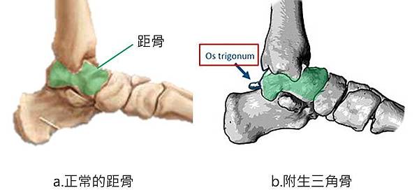 os trigonum比較圖.jpg