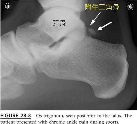 os-trigonum Xray.jpg