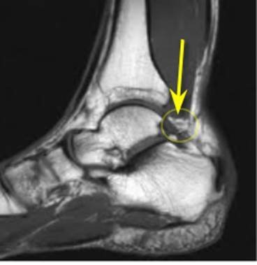 os-trigonum MRI.jpg