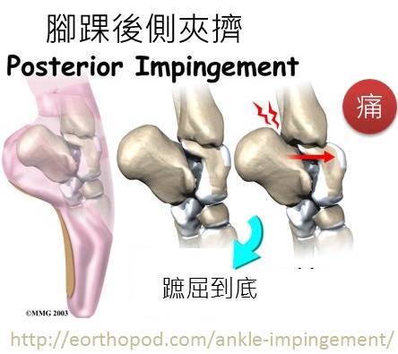 夾擠痛.jpg 夾擠痛.jpg