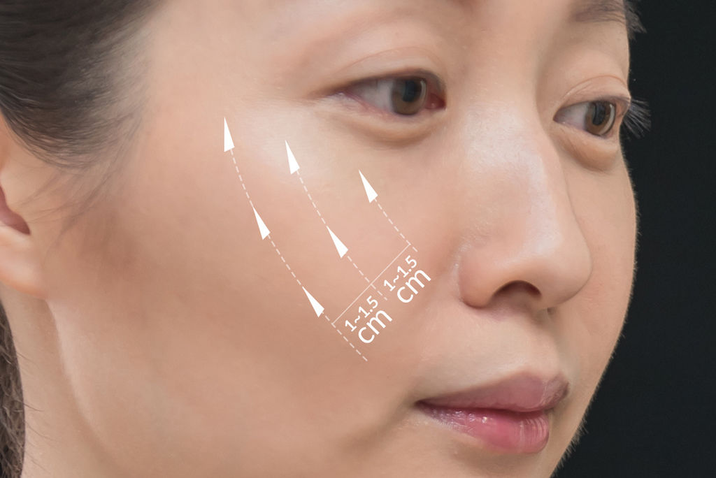 埋線拉提DNA螺旋式拉提埋線拉提副作用埋線拉提失敗埋線拉提費用埋線拉提推薦02.jpg 埋線拉提DNA螺旋式拉提埋線拉提副作用埋線拉提失敗埋線拉提費用埋線拉提推薦02.jpg