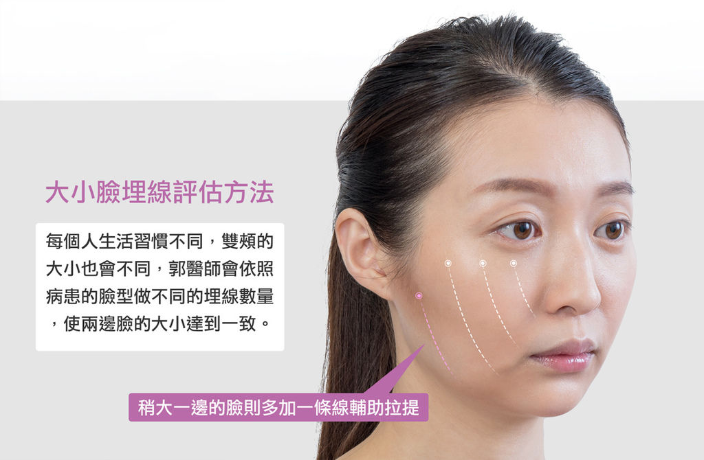 埋線拉提DNA螺旋式拉提埋線拉提副作用埋線拉提失敗埋線拉提費用埋線拉提推薦04new.jpg 埋線拉提DNA螺旋式拉提埋線拉提副作用埋線拉提失敗埋線拉提費用埋線拉提推薦04new.jpg