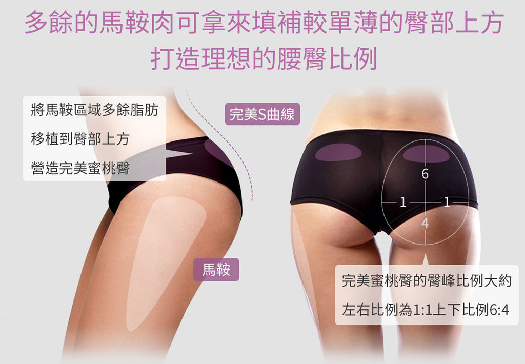 臀部抽脂抽脂手術風險抽脂價格抽脂後遺症抽脂日記抽脂會痛嗎02.jpg 臀部抽脂抽脂手術風險抽脂價格抽脂後遺症抽脂日記抽脂會痛嗎02.jpg
