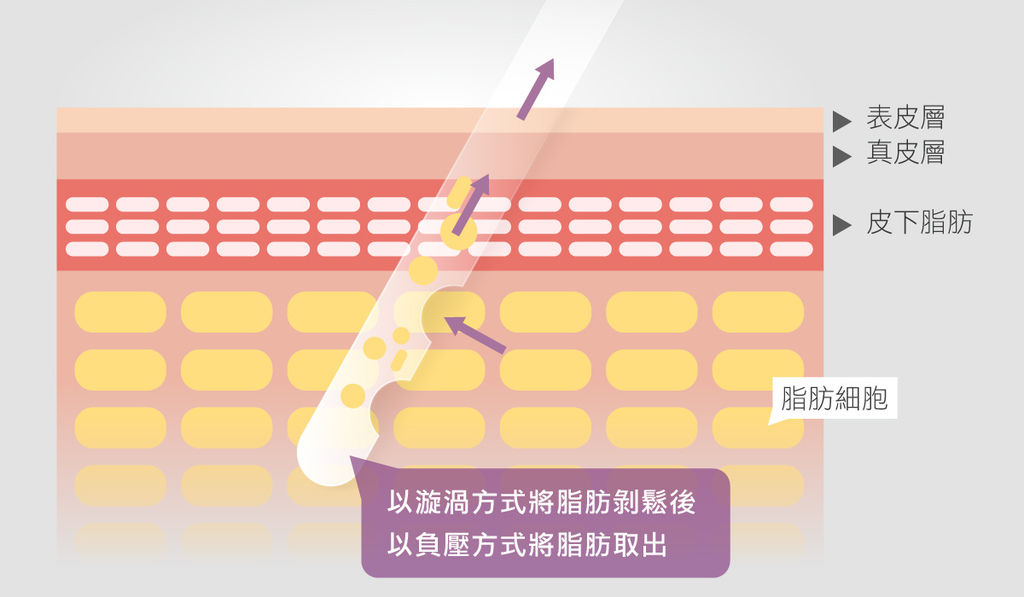 光彩渦旋抽脂.jpg 光彩渦旋抽脂.jpg