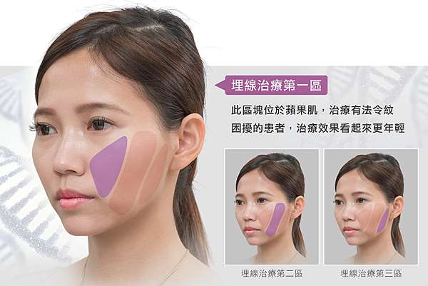 埋線拉提第一區 解除法令紋年輕十歲沒問題 光彩時尚診所shine Aesthetic Clinic 痞客邦
