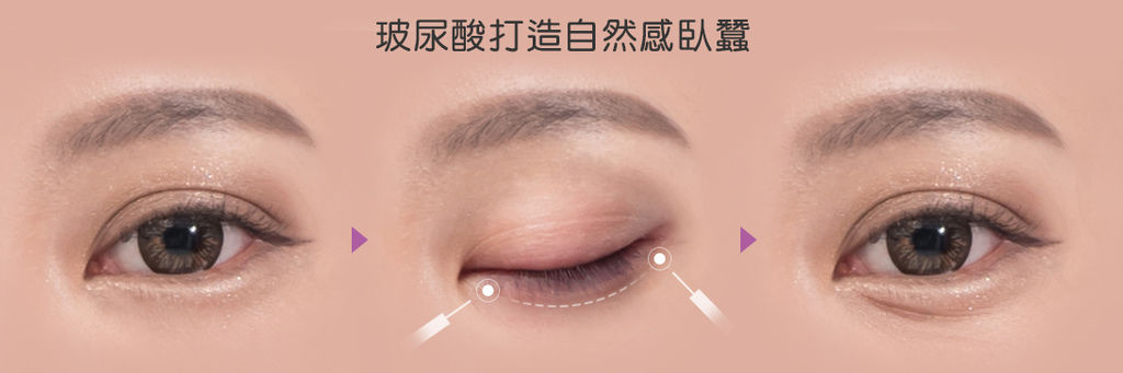 玻尿酸臥蠶ptt玻尿酸臥蠶推薦玻尿酸臥蠶費用光彩時尚診所郭弘義醫師03.jpg 玻尿酸臥蠶ptt玻尿酸臥蠶推薦玻尿酸臥蠶費用光彩時尚診所郭弘義醫師03.jpg