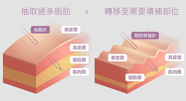 渦旋抽脂渦旋抽脂費用光彩時尚診所評價光彩抽脂光彩時尚診所抽脂郭弘義02.jpg 渦旋抽脂渦旋抽脂費用光彩時尚診所評價光彩抽脂光彩時尚診所抽脂郭弘義02.jpg