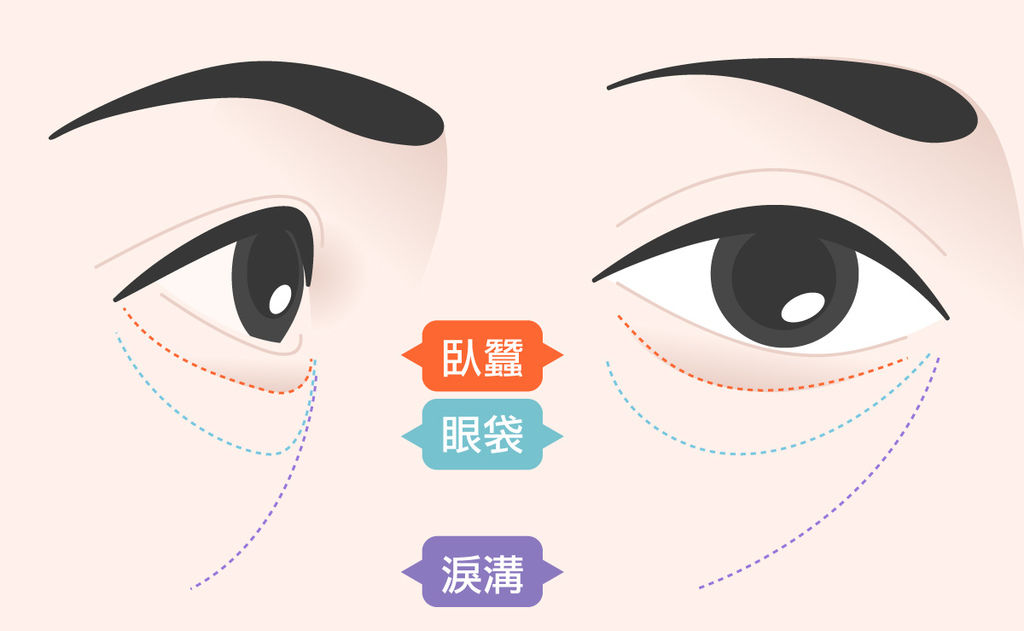 玻尿酸臥蠶ptt玻尿酸臥蠶推薦玻尿酸臥蠶費用光彩時尚診所郭弘義醫師02.jpg 玻尿酸臥蠶ptt玻尿酸臥蠶推薦玻尿酸臥蠶費用光彩時尚診所郭弘義醫師02.jpg