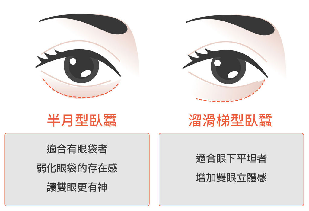 玻尿酸臥蠶ptt玻尿酸臥蠶推薦玻尿酸臥蠶費用光彩時尚診所郭弘義醫師04.jpg 玻尿酸臥蠶ptt玻尿酸臥蠶推薦玻尿酸臥蠶費用光彩時尚診所郭弘義醫師04.jpg