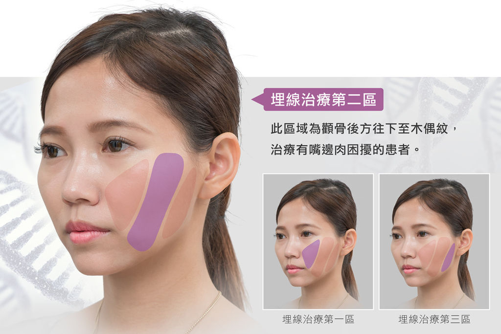 埋線拉提副作用埋線拉提費用埋線拉提推薦埋線拉提術後埋線拉提ptt埋線拉提後遺症埋線拉提效果玫瑰線拉提價格4d埋線拉皮推薦平滑線拉提嘴邊肉治療推薦光彩時尚診所郭弘義醫師05.jpg 埋線拉提副作用埋線拉提費用埋線拉提推薦埋線拉提術後埋線拉提ptt埋線拉提後遺症埋線拉提效果玫瑰線拉提價格4d埋線拉皮推薦平滑線拉提嘴邊肉治療推薦光彩時尚診所郭弘義醫師05.jpg