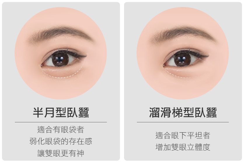 玻尿酸臥蠶ptt玻尿酸臥蠶推薦玻尿酸臥蠶費用光彩時尚診所郭弘義醫師04.jpg 玻尿酸臥蠶ptt玻尿酸臥蠶推薦玻尿酸臥蠶費用光彩時尚診所郭弘義醫師04.jpg
