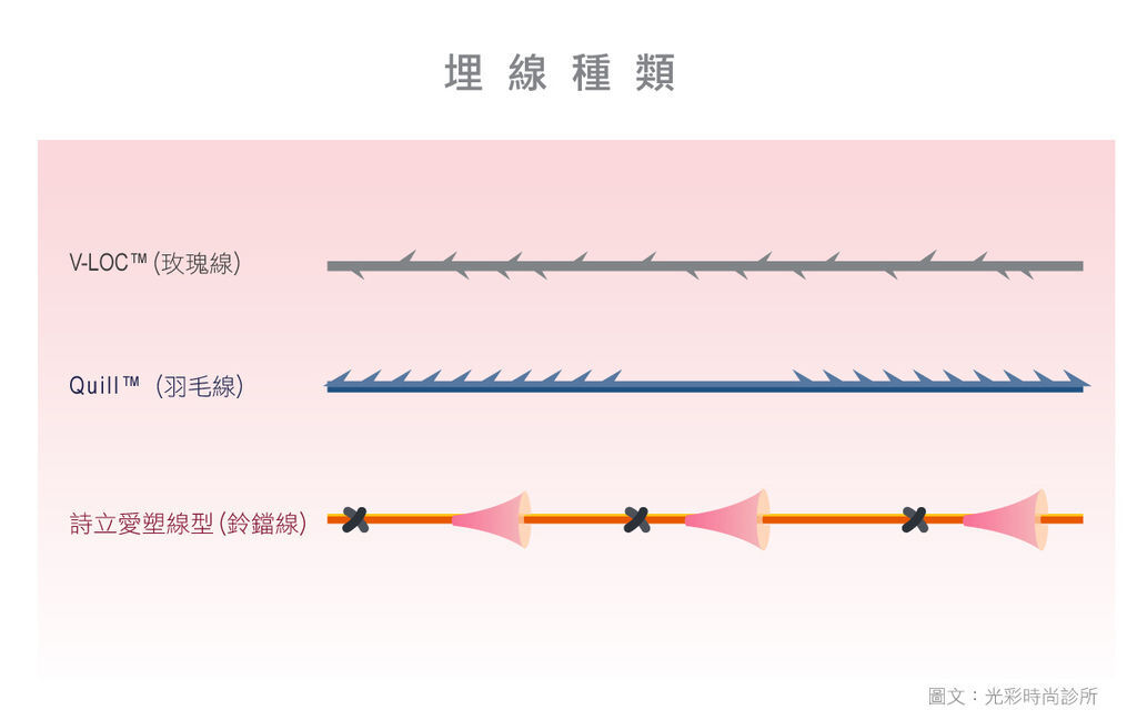 埋線拉皮埋線拉提Quill羽毛線埋線拉提價格埋線拉皮費用埋線拉皮推薦光彩時尚診所郭弘義醫師台北東區診所拉提推薦多少錢02.jpg