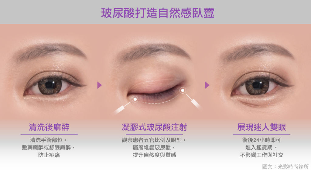 光彩時尚診所玻尿酸郭弘義醫師玻尿酸臥蠶臥蠶比例顏值自然臥蠶東區醫美推薦04.jpg 光彩時尚診所玻尿酸郭弘義醫師玻尿酸臥蠶臥蠶比例顏值自然臥蠶東區醫美推薦04.jpg
