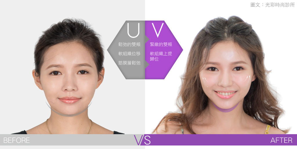 光彩kitty埋線埋線拉提失敗埋線拉提費用埋線拉提副作用埋線拉提ptt埋線拉提推薦埋線拉提後遺症埋線拉提術後埋線拉提恢復期臉部埋線拉提費用中醫埋線拉提雙下巴醫美雙下巴.jpg 埋線拉提失敗埋線拉提費用埋線拉提副作用埋線拉提ptt埋線拉提推薦埋線拉提後遺症埋線拉提術後埋線拉提恢復期臉部埋線拉提費用中醫埋線拉提雙下巴醫美雙下巴.jpg