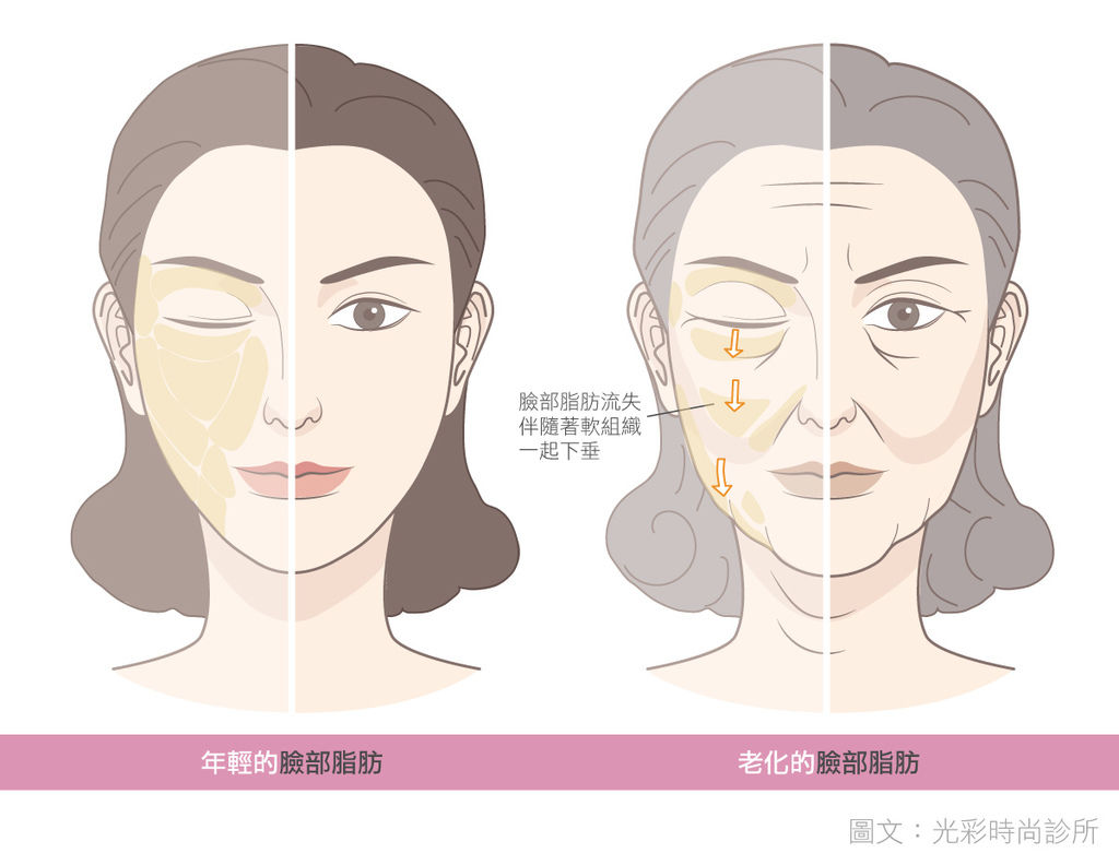 臉部脂肪對比埋線拉提失敗埋線拉提費用埋線拉提副作用埋線拉提ptt埋線拉提推薦埋線拉提後遺症埋線拉提術後埋線拉提恢復期臉部埋線拉提費用中醫埋線拉提雙下巴醫美雙下巴.jpg 臉部脂肪對比埋線拉提失敗埋線拉提費用埋線拉提副作用埋線拉提ptt埋線拉提推薦埋線拉提後遺症埋線拉提術後埋線拉提恢復期臉部埋線拉提費用中醫埋線拉提雙下巴醫美雙下巴.jpg
