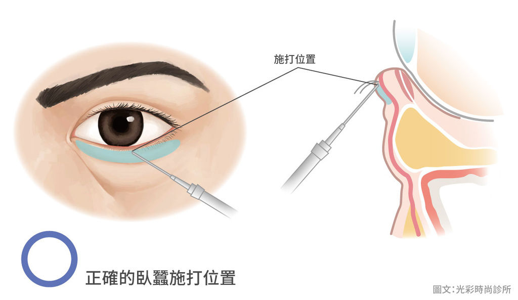 正確的臥蠶施打位置.jpg