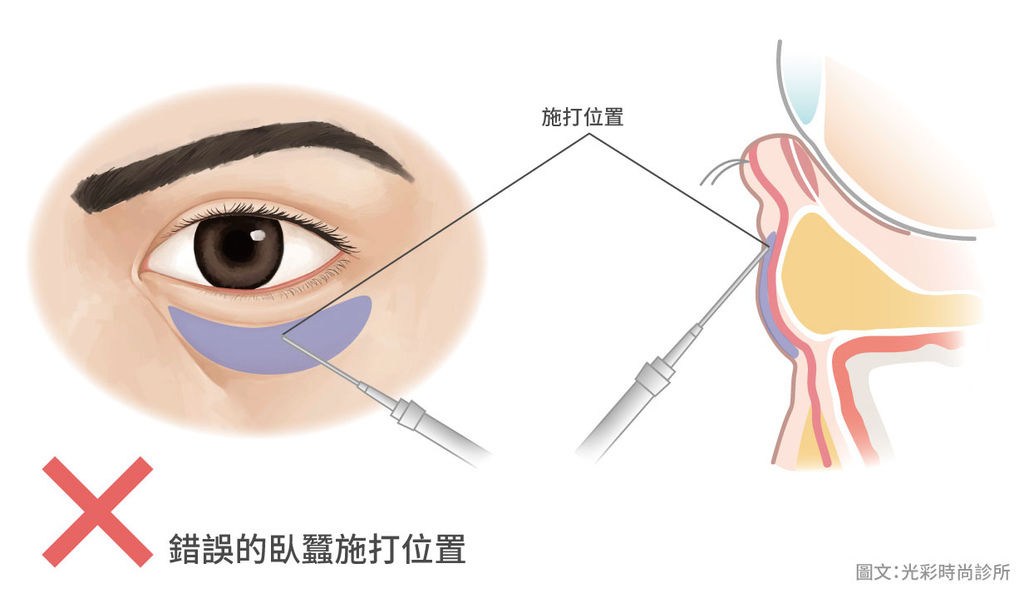 錯誤的臥蠶施打位置.jpg