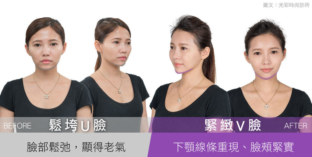 埋線拉提失敗埋線拉提費用埋線拉提副作用埋線拉提ptt埋線拉提推薦埋線拉提後遺症埋線拉提術後埋線拉提恢復期臉部埋線拉提費用中醫埋線拉提雙下巴醫美雙下巴拉提雙下巴運動下顎線拉提下顎線輪廓線臉部埋線費用光彩kitty下顎線.jpg 埋線拉提失敗埋線拉提費用埋線拉提副作用埋線拉提ptt埋線拉提推薦埋線拉提後遺症埋線拉提術後埋線拉提恢復期臉部埋線拉提費用中醫埋線拉提雙下巴醫美雙下巴拉提雙下巴運動下顎線拉提下顎線輪廓線臉部埋線費用光彩kitty下顎線.jpg