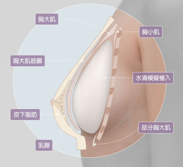 胸部構造內視鏡隆乳水滴隆乳內視鏡隆乳費用評價台北隆乳推薦台北內視鏡隆乳東區醫美東區隆乳推薦內視鏡隆乳術後恢復期術後可以上班嗎台北隆乳貴嗎絨毛果凍隆乳內視鏡郭弘義醫師光彩時尚診所腋下開口乳暈乳房餵母奶肚臍隆乳維持多久隆乳破掉隆乳按摩高雄內視鏡隆乳水滴隆乳缺點內視鏡隆乳手術免按摩後悔.png