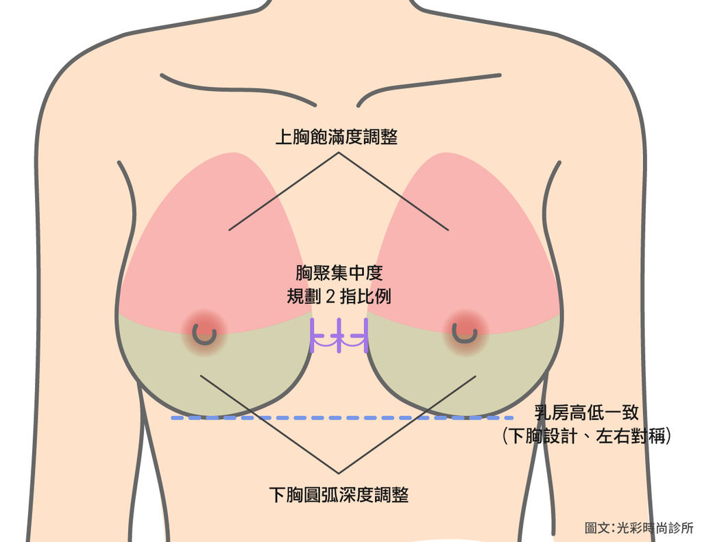 果凍隆乳隆乳2018隆乳案例台北隆乳推薦果凍型矽膠隆乳隆乳變軟內視鏡價格.jpg