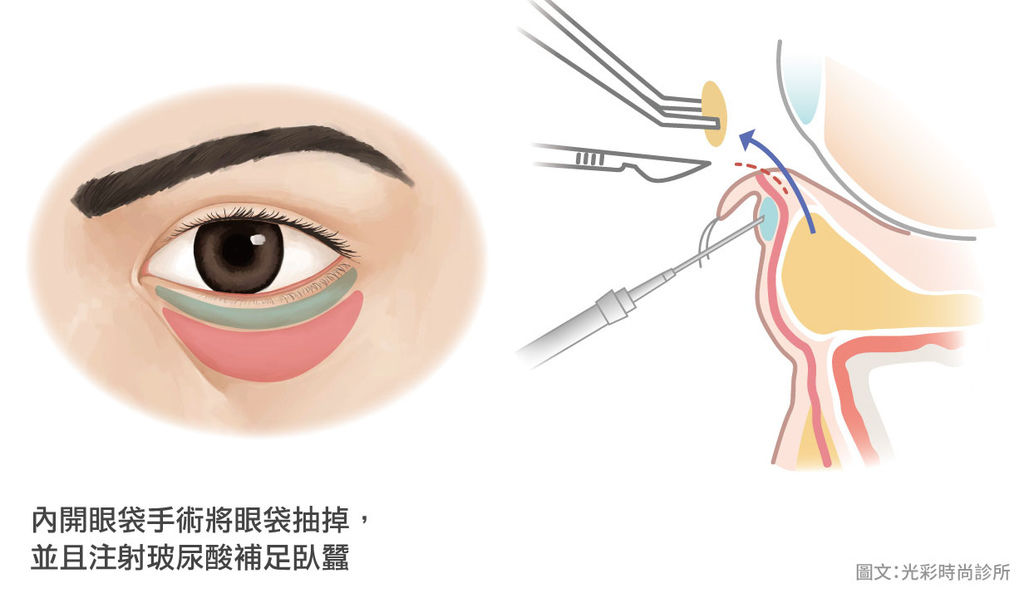 消除下眼袋消除眼袋眼霜消除眼袋的方法消除眼袋的好方法如何自然消除眼袋眼袋成因眼袋手術內開眼袋玻尿酸注射玻.jpg