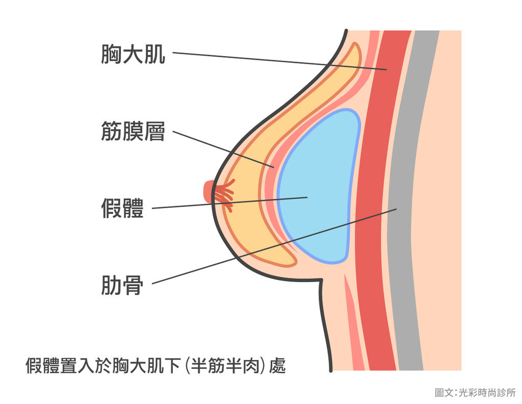 內視鏡隆乳隆乳手術風險水滴形絨毛矽膠隆乳乳房發育隆乳價格豐胸手術內視鏡光彩時尚診所台北醫美推薦果凍隆乳水滴隆乳假體置入於胸大肌下(半筋半肉)處.jpg